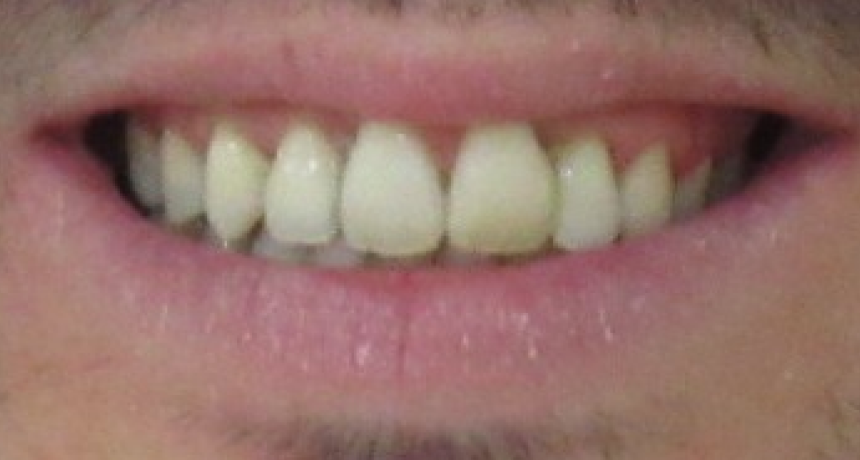 Traitement par appareils dentaires Orthodontiste spécialiste à Paris 18, Dr Mehdi Sersab
