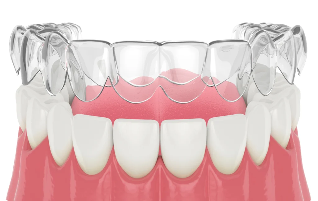 La contention Orthodontiste spécialiste à Paris 18, Dr Mehdi Sersab