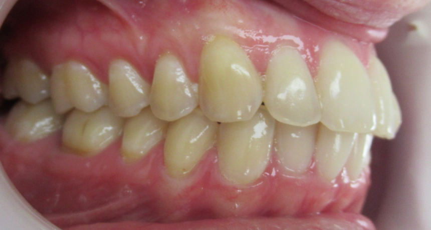 Traitement par gouttières invisibles Orthodontiste spécialiste à Paris 18, Dr Mehdi Sersab