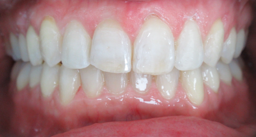 Traitement par gouttières invisibles Orthodontiste spécialiste à Paris 18, Dr Mehdi Sersab