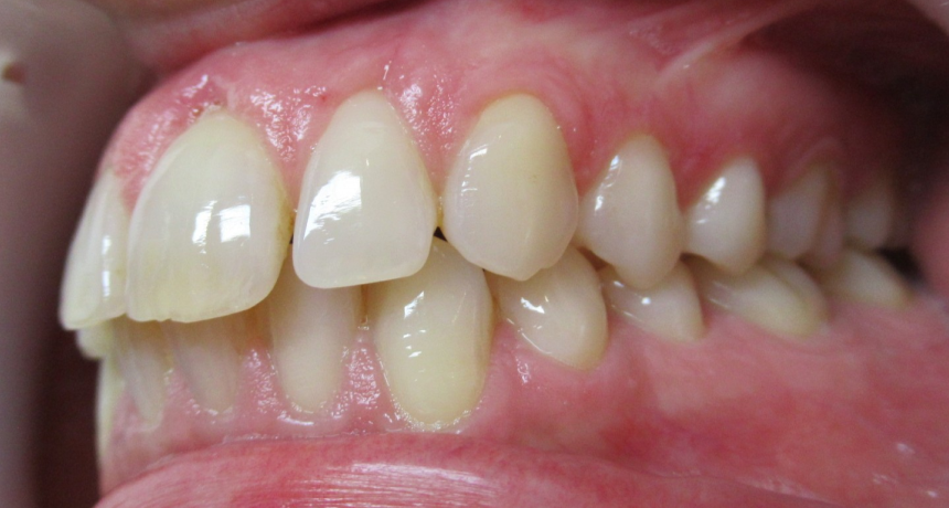 Traitement par gouttières invisibles Orthodontiste spécialiste à Paris 18, Dr Mehdi Sersab