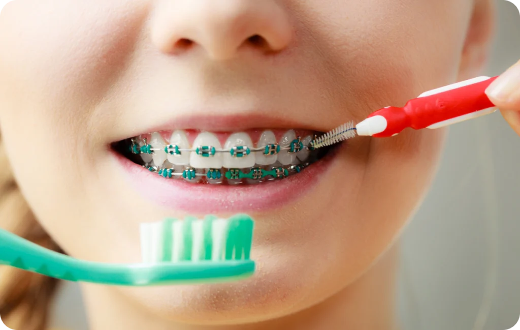 Hygiène bucco-dentaire pendant un traitement orthodontique Orthodontiste spécialiste à Paris 18 | Dr Mehdi Sersab