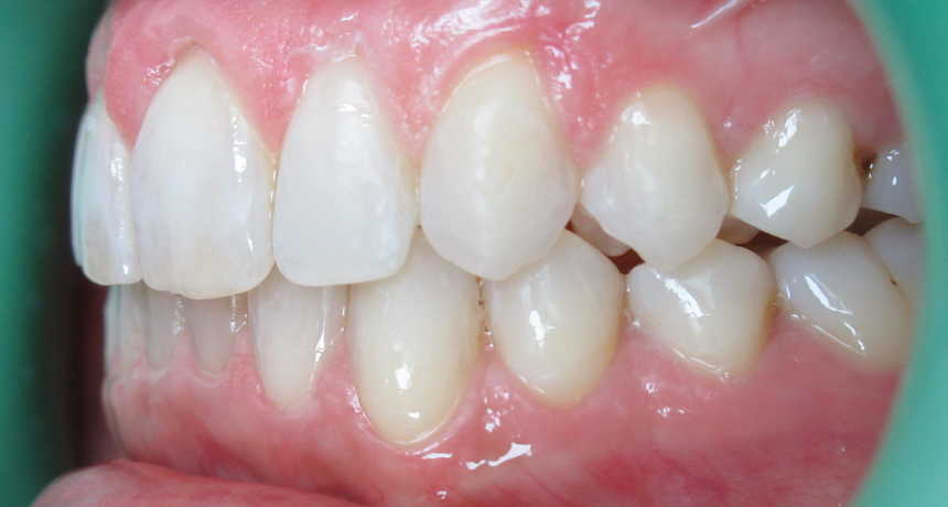 Traitement par gouttières invisibles Orthodontiste spécialiste à Paris 18, Dr Mehdi Sersab