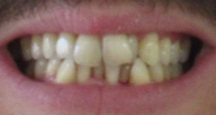 Traitement par appareils dentaires Orthodontiste spécialiste à Paris 18, Dr Mehdi Sersab