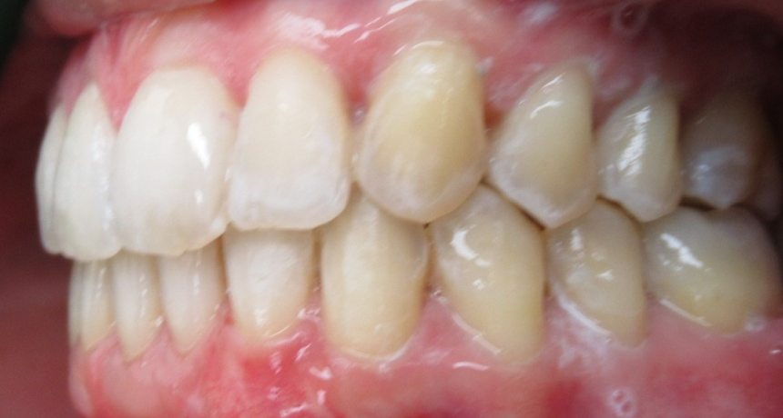 Traitement par gouttières invisibles Orthodontiste spécialiste à Paris 18, Dr Mehdi Sersab
