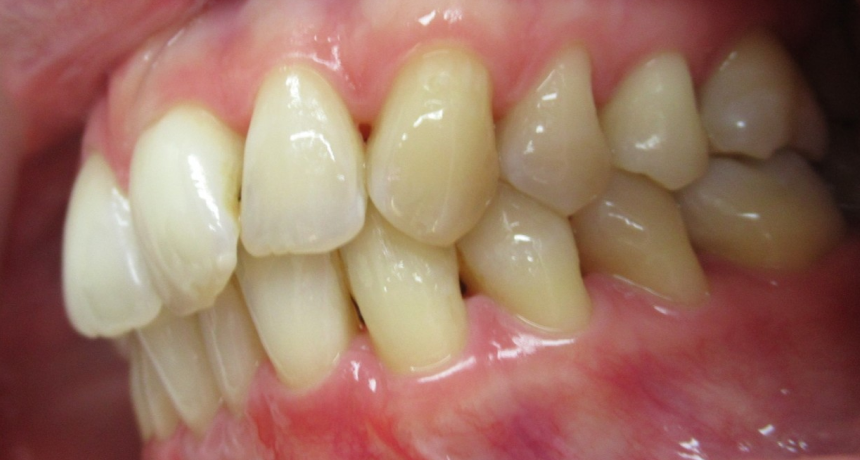 Traitement par gouttières invisibles Orthodontiste spécialiste à Paris 18, Dr Mehdi Sersab