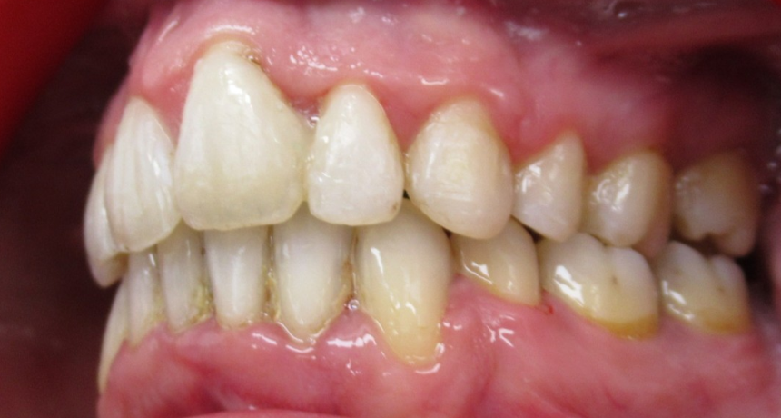 Traitement par appareils dentaires Orthodontiste spécialiste à Paris 18, Dr Mehdi Sersab