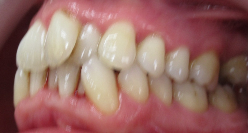 Traitement par appareils dentaires Orthodontiste spécialiste à Paris 18, Dr Mehdi Sersab