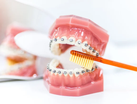 Hygiène bucco-dentaire pendant un traitement orthodontique Orthodontiste spécialiste à Paris 18 | Dr Mehdi Sersab