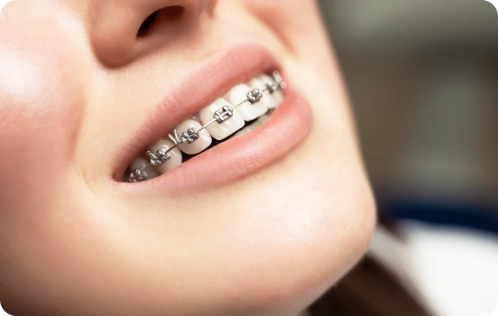 Aligneurs transparents ou appareil orthodontique : comment faire le bon choix ? Orthodontiste spécialiste à Paris 18, Dr Mehdi Sersab
