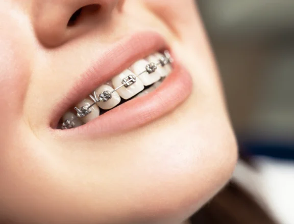 Aligneurs transparents ou appareil orthodontique : comment faire le bon choix ? Orthodontiste spécialiste à Paris 18, Dr Mehdi Sersab