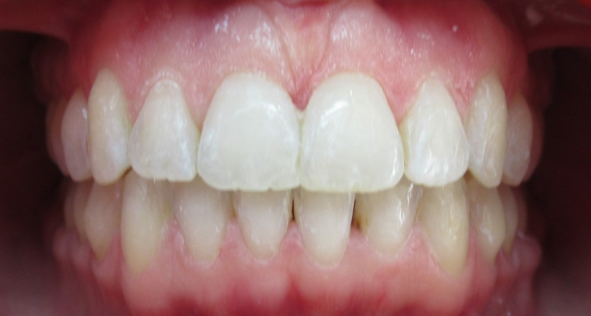 Traitement par gouttières invisibles Orthodontiste spécialiste à Paris 18, Dr Mehdi Sersab