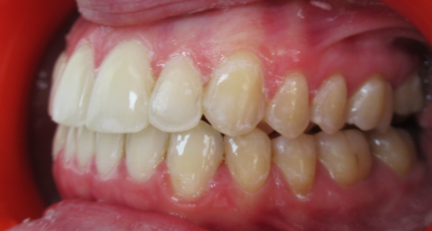 Traitement par gouttières invisibles Orthodontiste spécialiste à Paris 18, Dr Mehdi Sersab