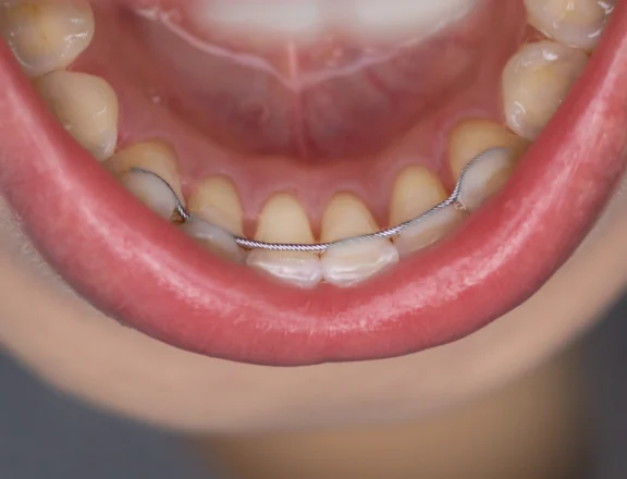 La contention Orthodontiste spécialiste à Paris 18, Dr Mehdi Sersab