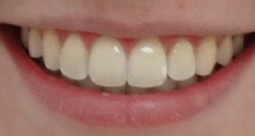 Traitement par gouttières invisibles Orthodontiste spécialiste à Paris 18, Dr Mehdi Sersab