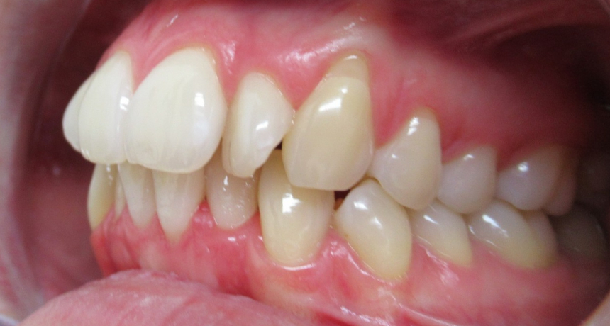 Traitement par gouttières invisibles Orthodontiste spécialiste à Paris 18, Dr Mehdi Sersab