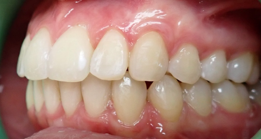 Traitement par gouttières invisibles Orthodontiste spécialiste à Paris 18, Dr Mehdi Sersab