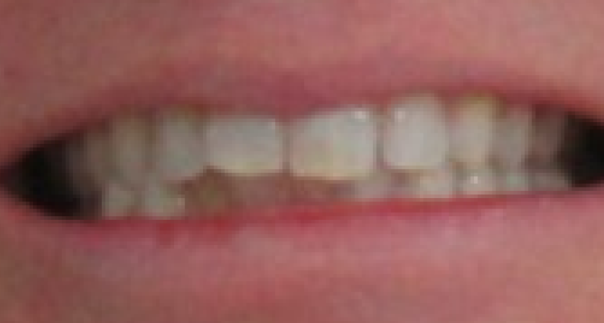 Traitement par gouttières invisibles Orthodontiste spécialiste à Paris 18, Dr Mehdi Sersab