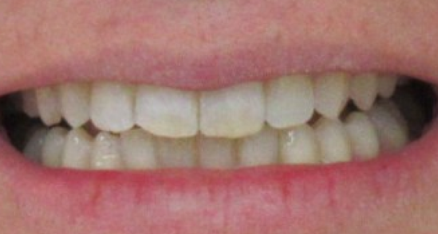Traitement par gouttières invisibles Orthodontiste spécialiste à Paris 18, Dr Mehdi Sersab