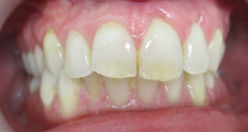 Traitement par gouttières invisibles Orthodontiste spécialiste à Paris 18, Dr Mehdi Sersab