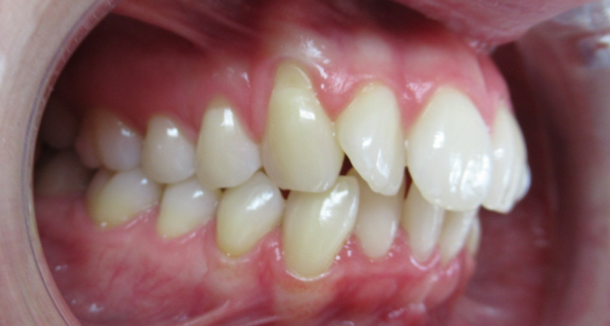 Traitement par gouttières invisibles Orthodontiste spécialiste à Paris 18, Dr Mehdi Sersab