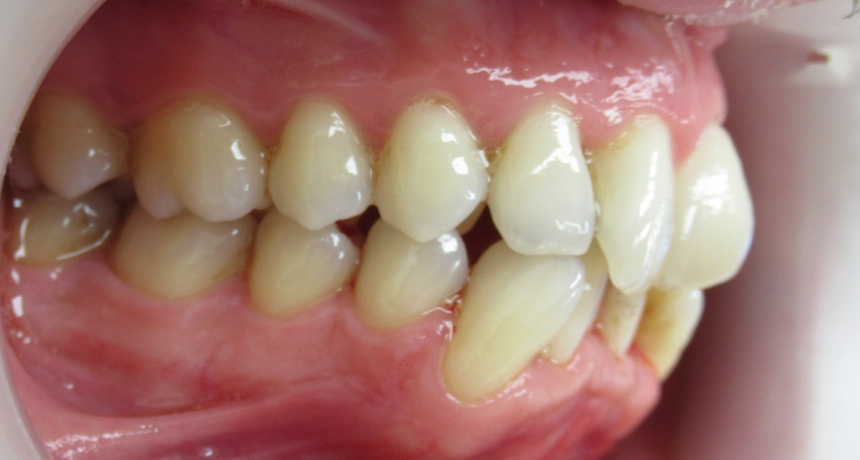 Traitement par appareils dentaires Orthodontiste spécialiste à Paris 18, Dr Mehdi Sersab