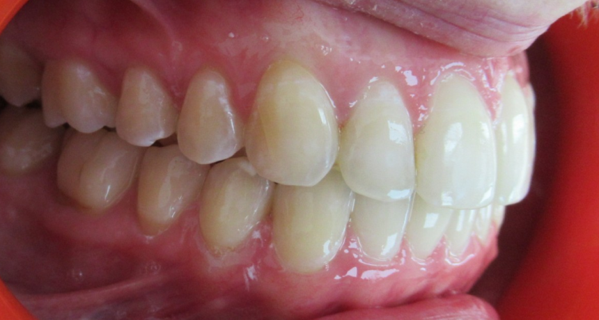 Traitement par gouttières invisibles Orthodontiste spécialiste à Paris 18, Dr Mehdi Sersab