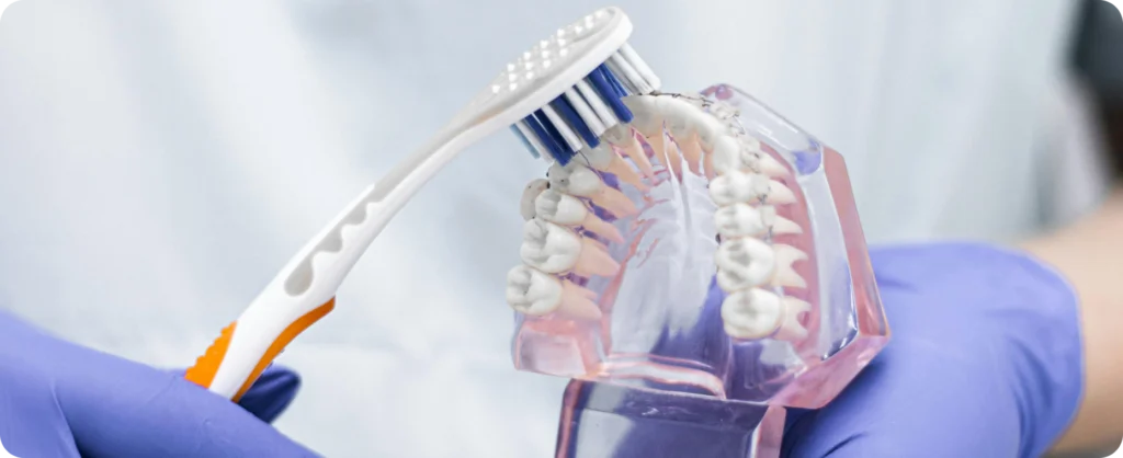 La contention Orthodontiste spécialiste à Paris 18, Dr Mehdi Sersab