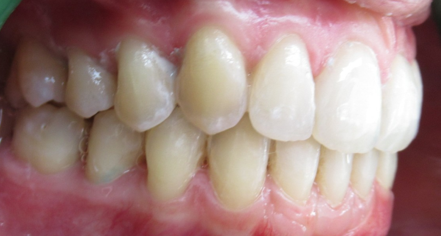 Traitement par gouttières invisibles Orthodontiste spécialiste à Paris 18, Dr Mehdi Sersab