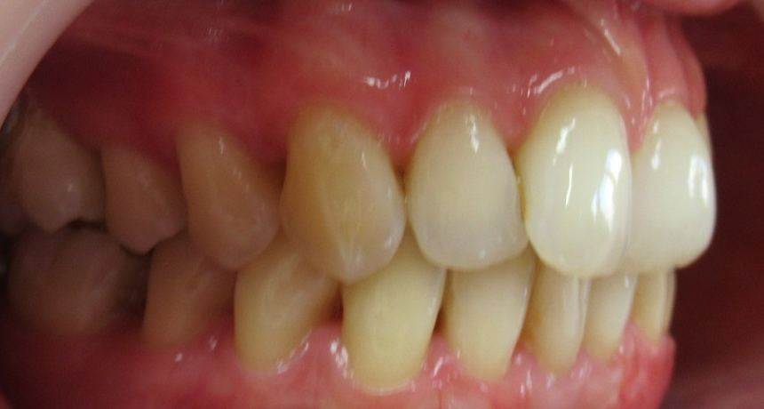 Traitement par gouttières invisibles Orthodontiste spécialiste à Paris 18, Dr Mehdi Sersab
