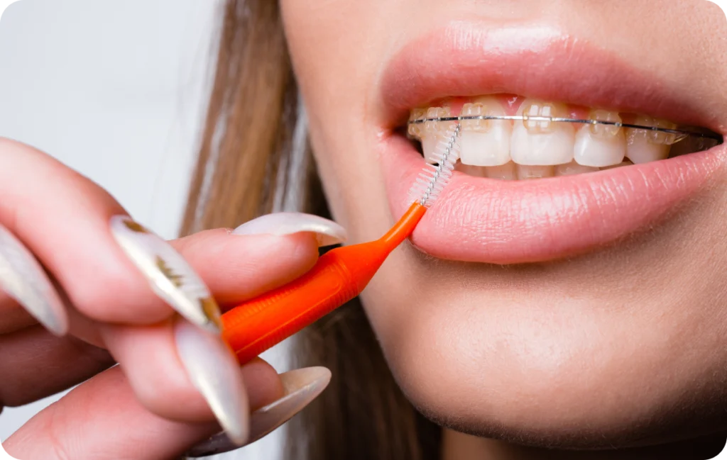Aligneurs transparents ou appareil orthodontique : comment faire le bon choix ? Orthodontiste spécialiste à Paris 18, Dr Mehdi Sersab