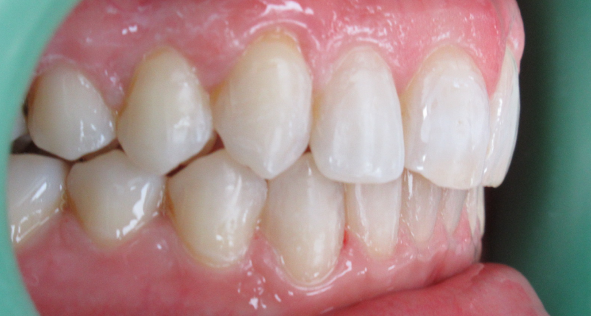 Traitement par gouttières invisibles Orthodontiste spécialiste à Paris 18, Dr Mehdi Sersab