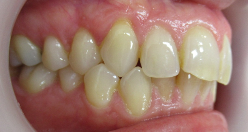 Traitement par gouttières invisibles Orthodontiste spécialiste à Paris 18, Dr Mehdi Sersab