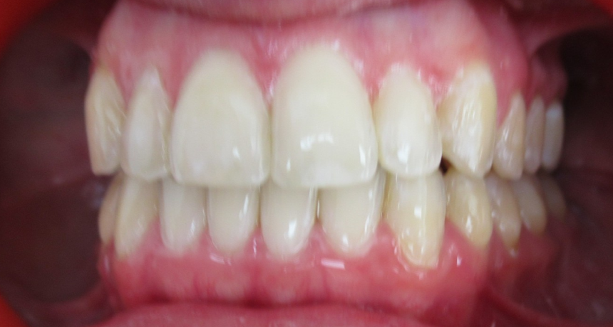 Traitement par gouttières invisibles Orthodontiste spécialiste à Paris 18, Dr Mehdi Sersab