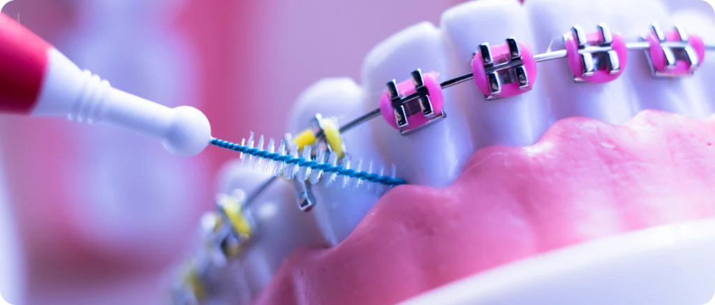 Hygiène bucco-dentaire pendant un traitement orthodontique Orthodontiste spécialiste à Paris 18 | Dr Mehdi Sersab
