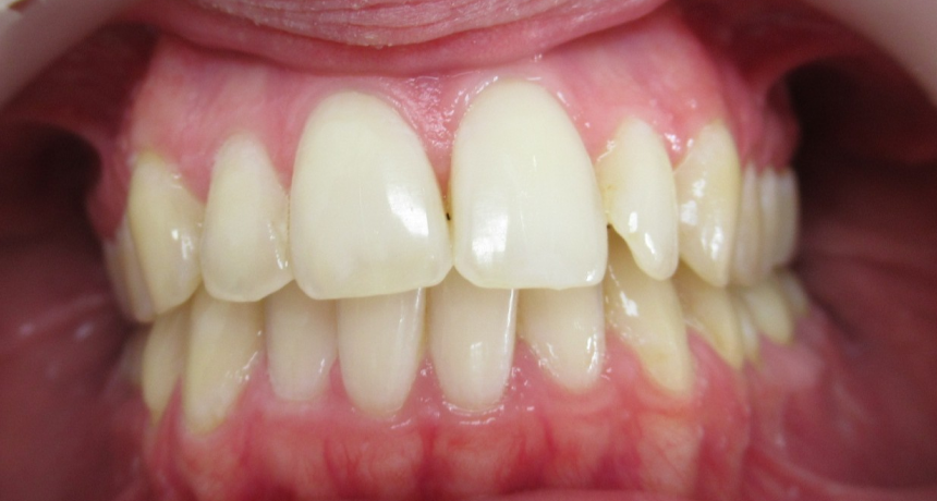 Traitement par gouttières invisibles Orthodontiste spécialiste à Paris 18, Dr Mehdi Sersab