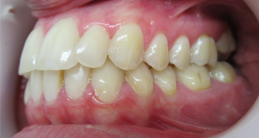 Traitement par gouttières invisibles Orthodontiste spécialiste à Paris 18, Dr Mehdi Sersab