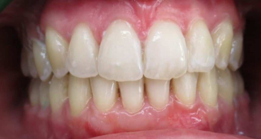 Traitement par gouttières invisibles Orthodontiste spécialiste à Paris 18, Dr Mehdi Sersab