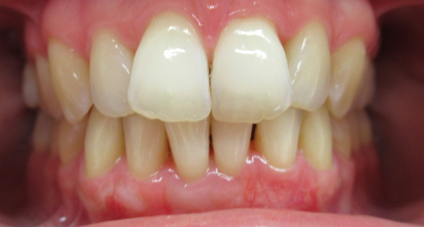 Traitement par gouttières invisibles Orthodontiste spécialiste à Paris 18, Dr Mehdi Sersab