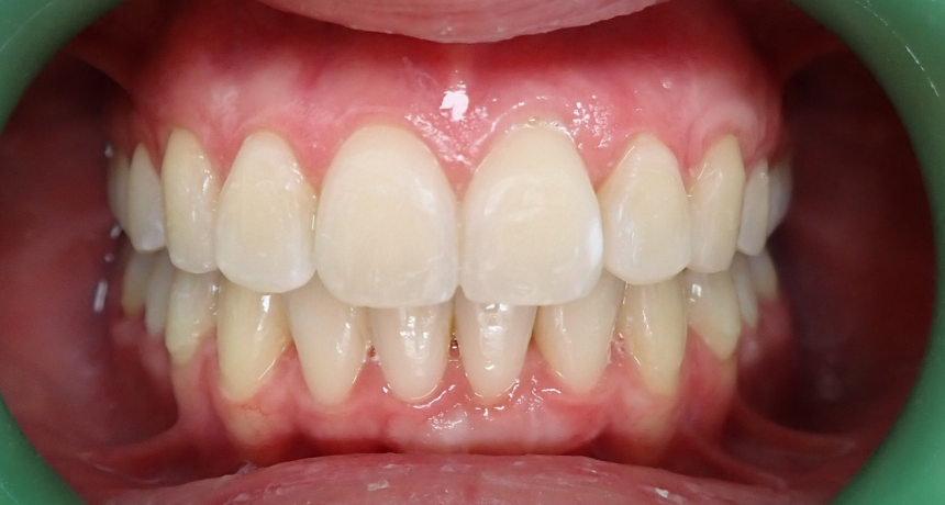 Traitement par gouttières invisibles Orthodontiste spécialiste à Paris 18, Dr Mehdi Sersab