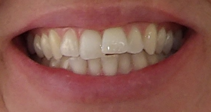 Traitement par gouttières invisibles Orthodontiste spécialiste à Paris 18, Dr Mehdi Sersab