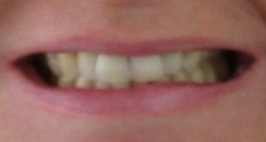 Traitement par gouttières invisibles Orthodontiste spécialiste à Paris 18, Dr Mehdi Sersab