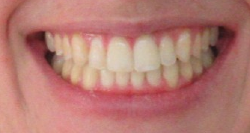 Traitement par gouttières invisibles Orthodontiste spécialiste à Paris 18, Dr Mehdi Sersab