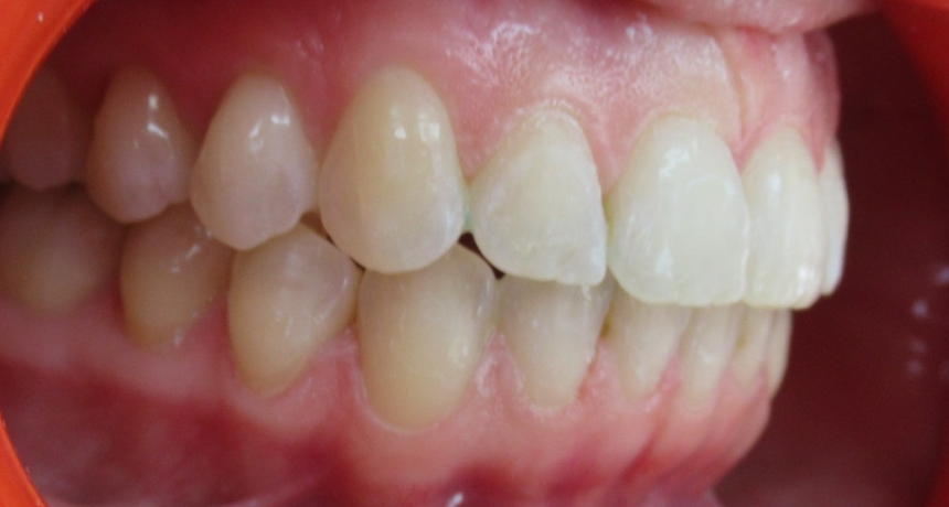 Traitement par gouttières invisibles Orthodontiste spécialiste à Paris 18, Dr Mehdi Sersab