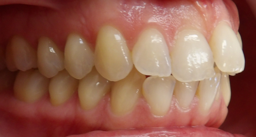 Traitement par gouttières invisibles Orthodontiste spécialiste à Paris 18, Dr Mehdi Sersab