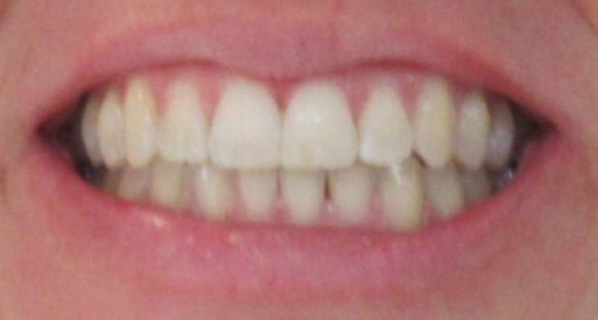 Traitement par gouttières invisibles Orthodontiste spécialiste à Paris 18, Dr Mehdi Sersab