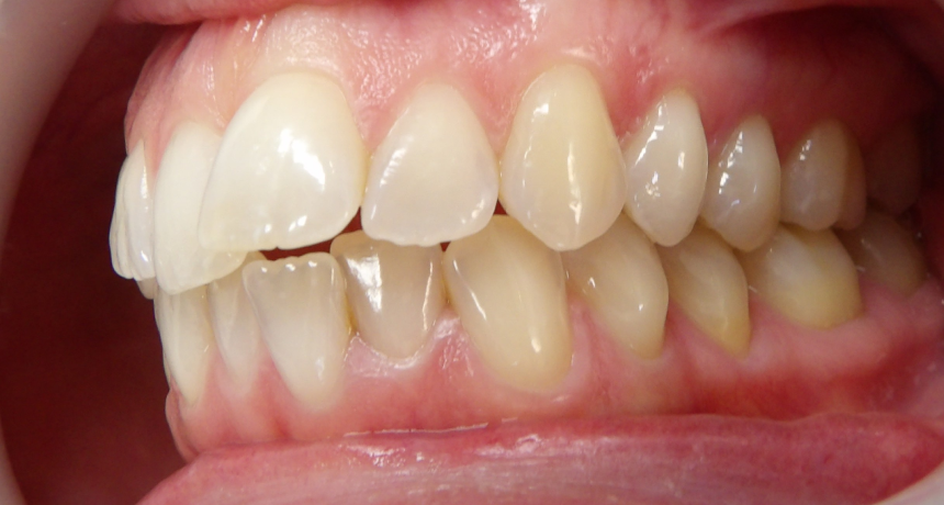 Traitement par gouttières invisibles Orthodontiste spécialiste à Paris 18, Dr Mehdi Sersab