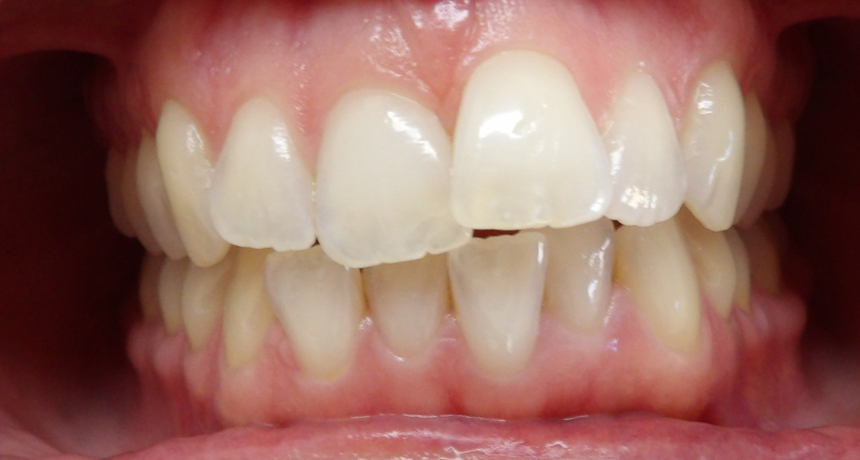 Traitement par gouttières invisibles Orthodontiste spécialiste à Paris 18, Dr Mehdi Sersab