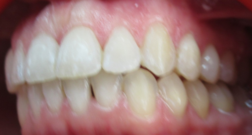 Traitement par gouttières invisibles Orthodontiste spécialiste à Paris 18, Dr Mehdi Sersab
