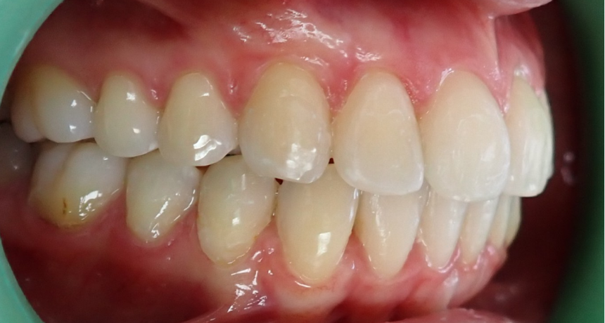 Traitement par gouttières invisibles Orthodontiste spécialiste à Paris 18, Dr Mehdi Sersab